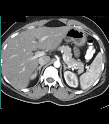 Splenic Artery Aneurysm Simulates An Islet Cell Tumor - CTisus CT Scan