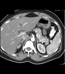 Renal Cell Carcinoma Which Extends Into the IVC With Unsuspected Pulmonary Emboli (PEs) - See Full Sequence - CTisus CT Scan