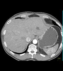 Renal Cell Carcinoma Which Extends Into the IVC With Unsuspected Pulmonary Emboli (PEs) - See Full Sequence - CTisus CT Scan