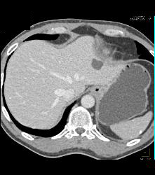 Renal Cell Carcinoma Which Extends Into the IVC With Unsuspected Pulmonary Emboli (PEs) - See Full Sequence - CTisus CT Scan