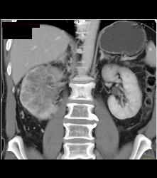 Renal Cell Carcinoma Which Extends Into the IVC With Unsuspected Pulmonary Emboli (PEs) - See Full Sequence - CTisus CT Scan