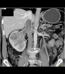 Renal Cell Carcinoma Which Extends Into the IVC With Unsuspected Pulmonary Emboli (PEs) - See Full Sequence - CTisus CT Scan