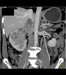 Renal Cell Carcinoma Which Extends Into the IVC With Unsuspected Pulmonary Emboli (PEs) - See Full Sequence - CTisus CT Scan