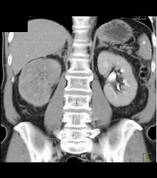 Renal Cell Carcinoma Which Extends Into the IVC With Unsuspected Pulmonary Emboli (PEs) - See Full Sequence - CTisus CT Scan