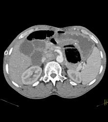 Full Sequence Shows Aortic Occlusion With Failed Grafts - CTisus CT Scan