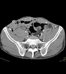 Full Sequence Shows Aortic Occlusion With Failed Grafts - CTisus CT Scan