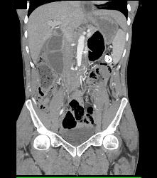 Full Sequence Shows Aortic Occlusion With Failed Grafts - CTisus CT Scan