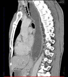 Achalasia - CTisus CT Scan