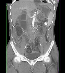 Occluded Abdominal Aorta - CTisus CT Scan