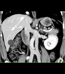 Duplication of Inferior Vena Cava (IVC) - CTisus CT Scan