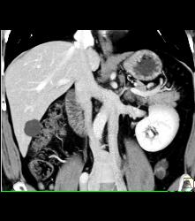 Duplication of Inferior Vena Cava (IVC) - CTisus CT Scan