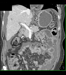 Cirrhosis With Portal Hypertension and Varices - CTisus CT Scan