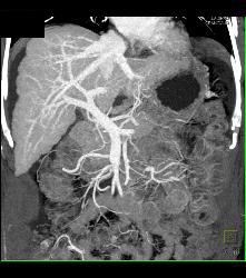 Cirrhosis With Portal Hypertension and Varices - CTisus CT Scan