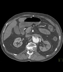 Decreased Function Left Kidney on Early Phase Images. Patient Has Reimplanted Left Renal Artery- See Sequence - CTisus CT Scan