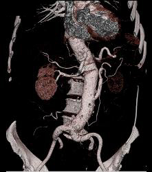 Decreased Function Left Kidney on Early Phase Images. Patient Has Reimplanted Left Renal Artery- See Sequence - CTisus CT Scan