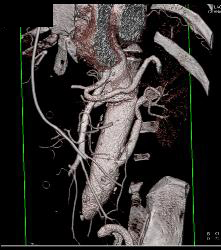 Decreased Function Left Kidney on Early Phase Images. Patient Has Reimplanted Left Renal Artery- See Sequence - CTisus CT Scan