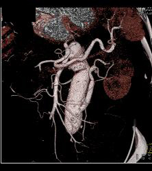 Decreased Function Left Kidney on Early Phase Images. Patient Has Reimplanted Left Renal Artery- See Sequence - CTisus CT Scan