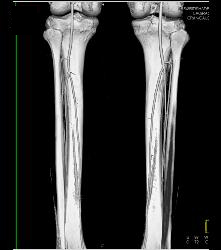 Runoff Study With Mild Peripheral Vascular Disease (PVD) - CTisus CT Scan