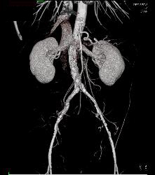 Runoff Study With Mild Peripheral Vascular Disease (PVD) - CTisus CT Scan