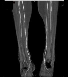 Runoff Study With Mild Peripheral Vascular Disease (PVD) - CTisus CT Scan