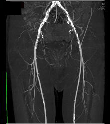 Runoff Study With Mild Peripheral Vascular Disease (PVD) - CTisus CT Scan