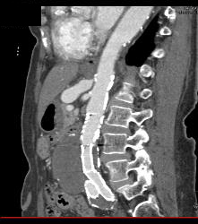 Celiac Artery Stenosis and Post Stenotic Dilation - CTisus CT Scan