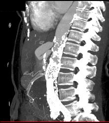 Celiac Artery Stenosis and Post Stenotic Dilation - CTisus CT Scan