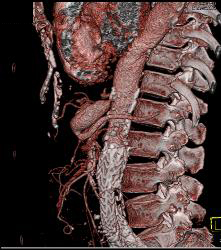 Celiac Artery Stenosis and Post Stenotic Dilation - CTisus CT Scan