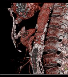 Celiac Artery Stenosis and Post Stenotic Dilation - CTisus CT Scan