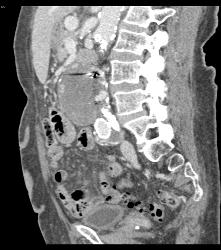 Endovascular Stent With Endoleak - CTisus CT Scan