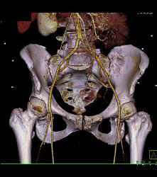 CTA of Iliacs With Auto-bone Removal - CTisus CT Scan