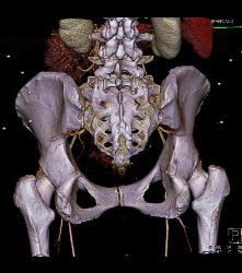 CTA of Iliacs With Auto-bone Removal - CTisus CT Scan