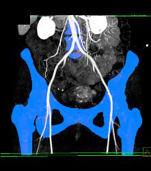 CTA of Iliacs With Auto-bone Removal - CTisus CT Scan