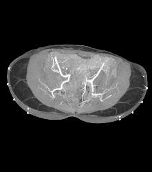 Sgap Flap Planning to Define Gluteal Arteries - CTisus CT Scan