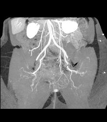 Sgap Flap Planning to Define Gluteal Arteries - CTisus CT Scan