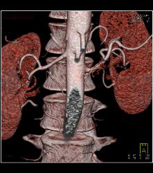 VRT and Renal Artery Mapping - CTisus CT Scan