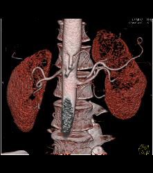 VRT and Renal Artery Mapping - CTisus CT Scan