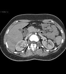 Small Caliber Aorta With Hardware Screw Abutting Aorta - CTisus CT Scan