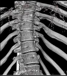 Small Caliber Aorta With Hardware Screw Abutting Aorta - CTisus CT Scan