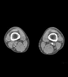 CTA Runoff in 3D With Editing and Peripheral Vascular Disease (PVD) - CTisus CT Scan