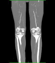 CTA Runoff in 3D With Editing and Peripheral Vascular Disease (PVD) - CTisus CT Scan