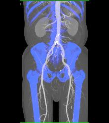 CTA Runoff in 3D With Editing and Peripheral Vascular Disease (PVD) - CTisus CT Scan