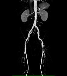 CTA Runoff in 3D With Editing and Peripheral Vascular Disease (PVD) - CTisus CT Scan