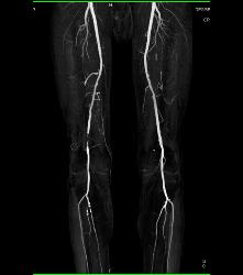 CTA Runoff in 3D With Editing and Peripheral Vascular Disease (PVD) - CTisus CT Scan