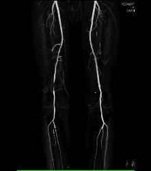 CTA Runoff in 3D With Editing and Peripheral Vascular Disease (PVD) - CTisus CT Scan