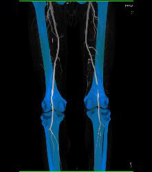 CTA Runoff in 3D With Editing and Peripheral Vascular Disease (PVD) - CTisus CT Scan