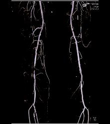 CTA Runoff in 3D With Editing and Peripheral Vascular Disease (PVD) - CTisus CT Scan