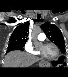 Perfectly Timed Pulmonary Embolism (PE) Study Although Contrast Is Still Being Injected- Less Contrast Can Be Used With Fast Scanning - CTisus CT Scan