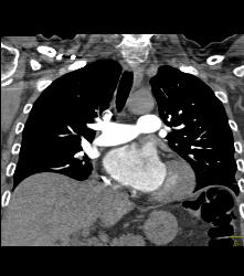 Perfectly Timed Pulmonary Embolism (PE) Study Although Contrast Is Still Being Injected- Less Contrast Can Be Used With Fast Scanning - CTisus CT Scan