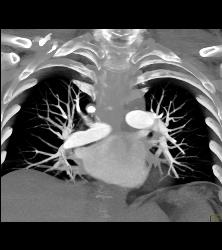 Perfectly Timed Pulmonary Embolism (PE) Study Although Contrast Is Still Being Injected- Less Contrast Can Be Used With Fast Scanning - CTisus CT Scan